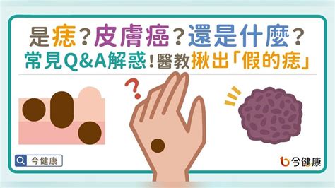 身體長痣的原因|是痣？皮膚癌？還是什麼？常見Q&A解惑！醫教揪出「。